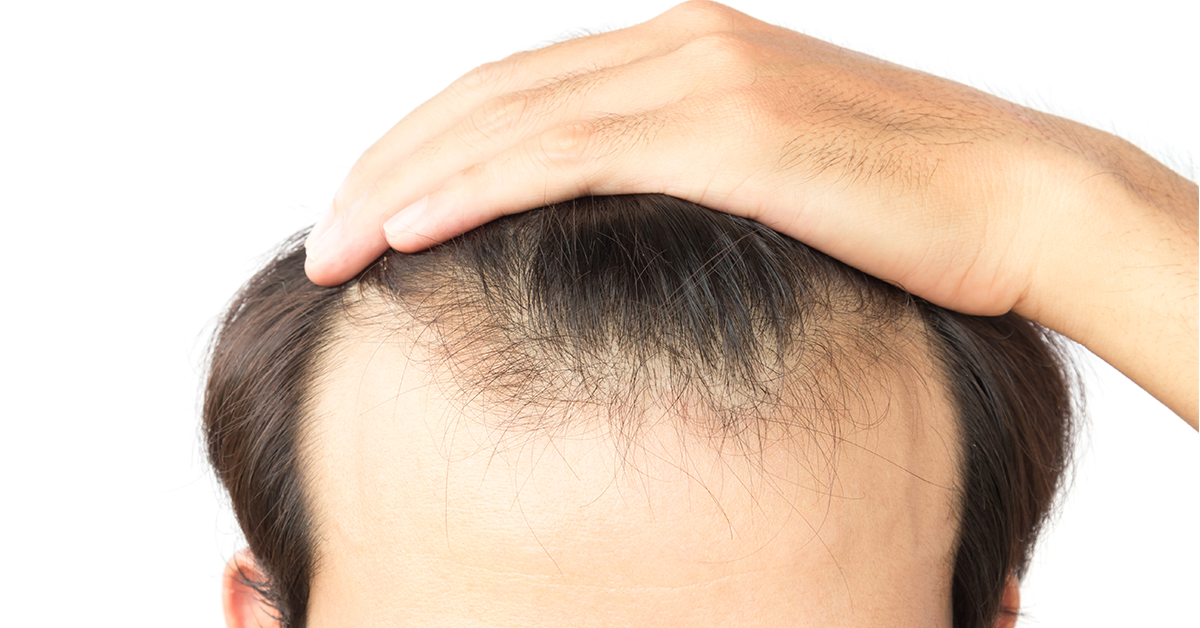 Hair Loss Solutions for Men: Top 5 Treatments for Balding and Thinning Hair  Lines | Vanilla Luxury