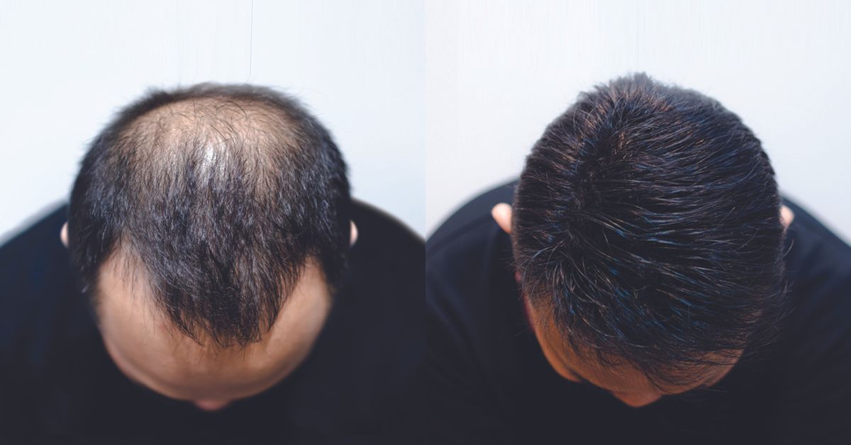 Rehair Lab - Instant, Effective and Easy to Maintain Hair Transplant Alternative
