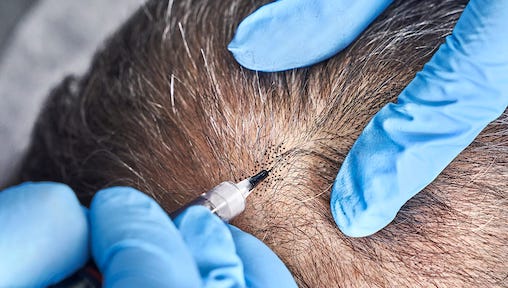 Ask The Hair Loss Expert Is Scalp Micro Pigmentation The Next Best Solution To A Hair Transplant Vanilla Luxury