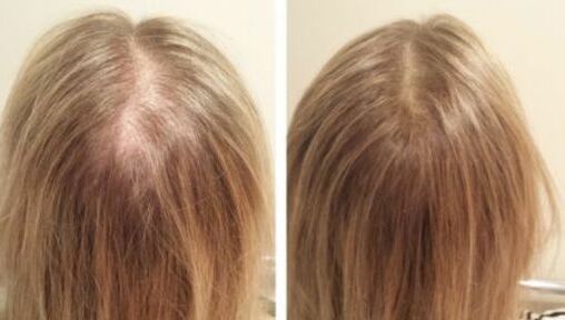 Hair Regrowth Treatments in Singapore To Combat Hair Loss and Promote Hair  Growth | Vanilla Luxury