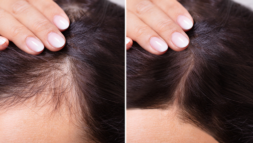 Hair Regrowth Treatments in Singapore To Combat Hair Loss and Promote Hair  Growth | Vanilla Luxury