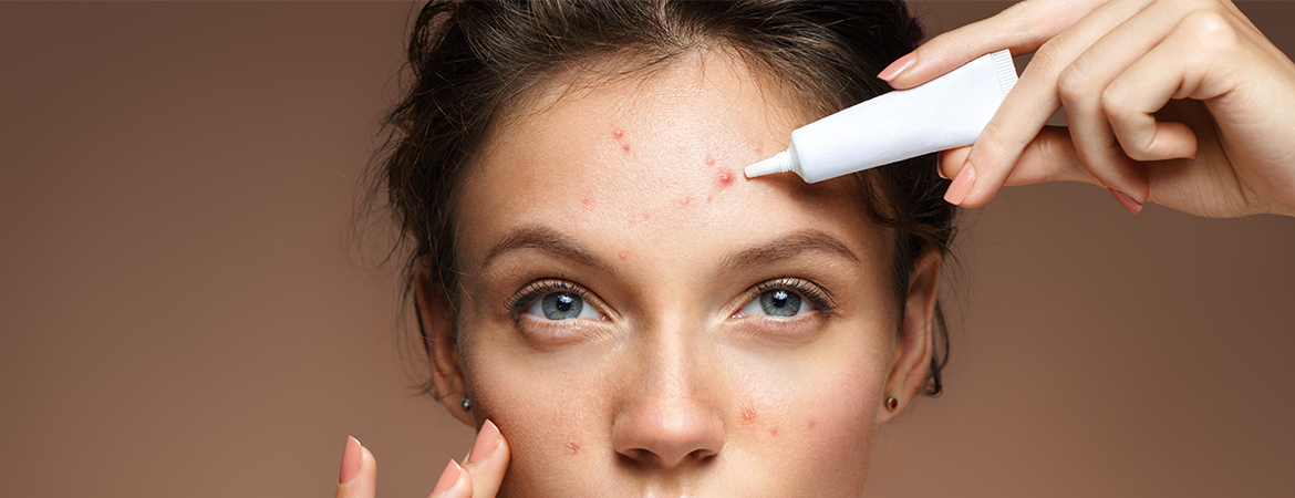Top Acne Treatments to Get Your Skin Glowing - Banner
