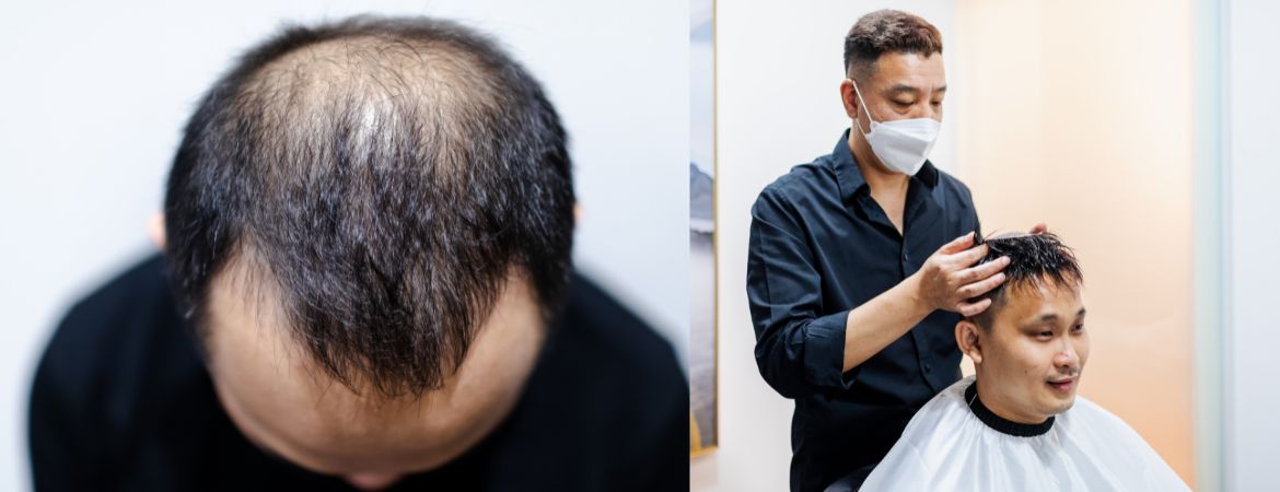 hair loss treatment singapore