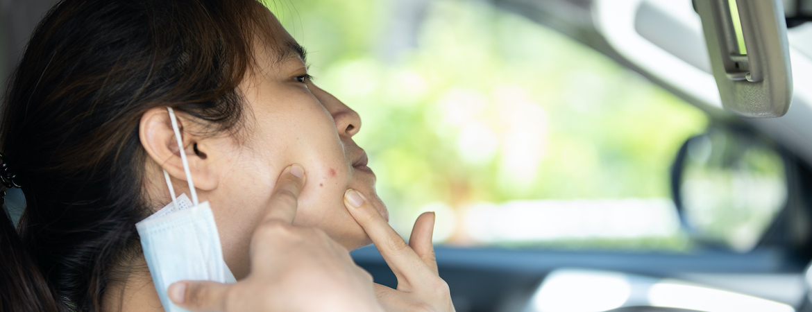 Top Acne Treatments and Skin care Products to Get Rid of Pimples and even Maskne Clear Skin: Acne & Maskne Treatments SG