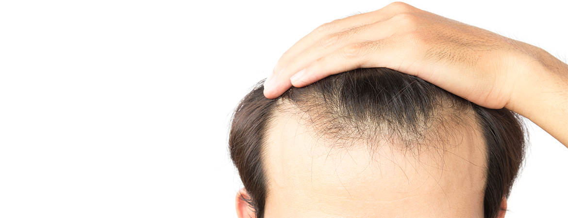 Hair Loss Solutions For Men Top 5 Treatments For Balding And
