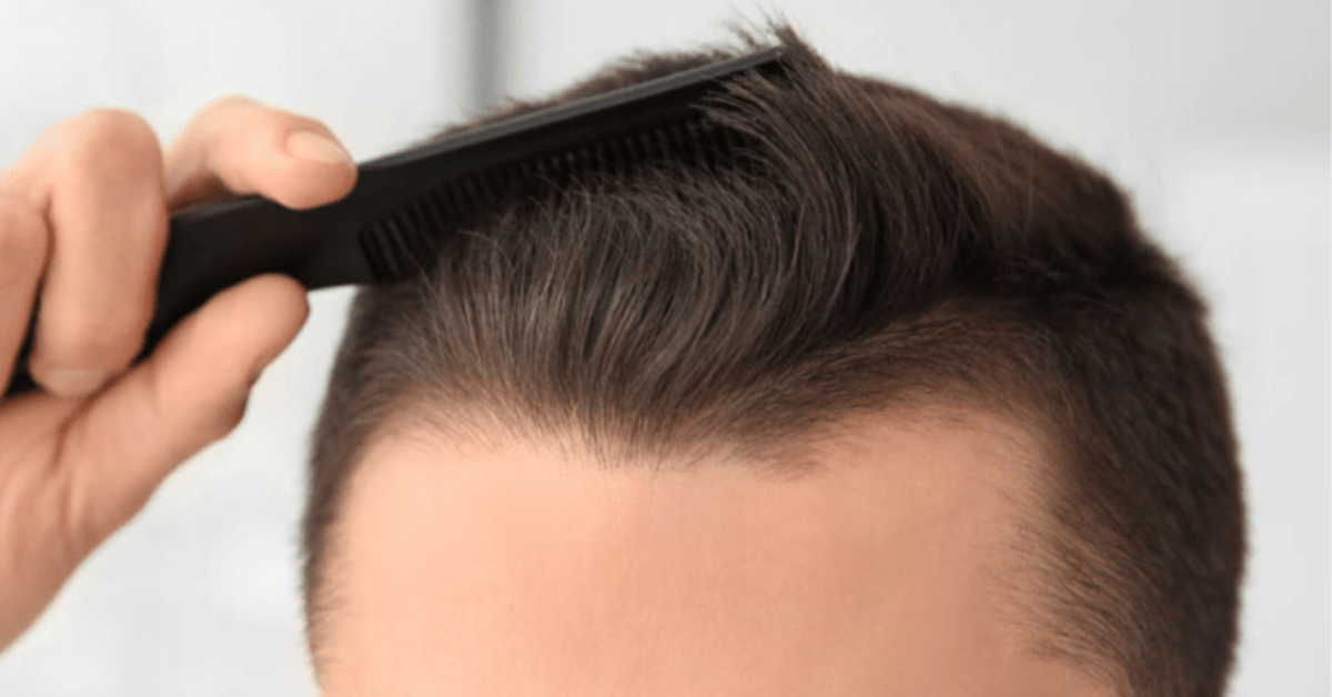 Best Hair Loss Treatments in Malaysia That You Need To Try Today