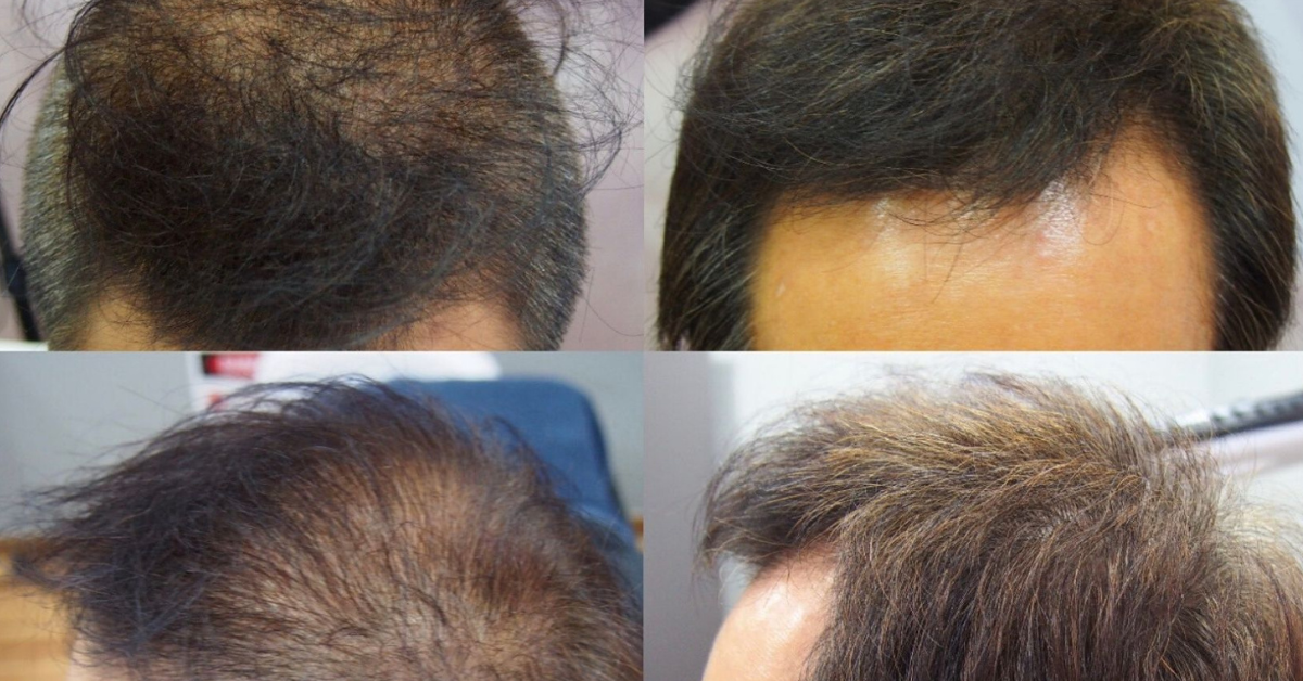 Best Hair Loss Treatments in Malaysia That You Need To Try Today