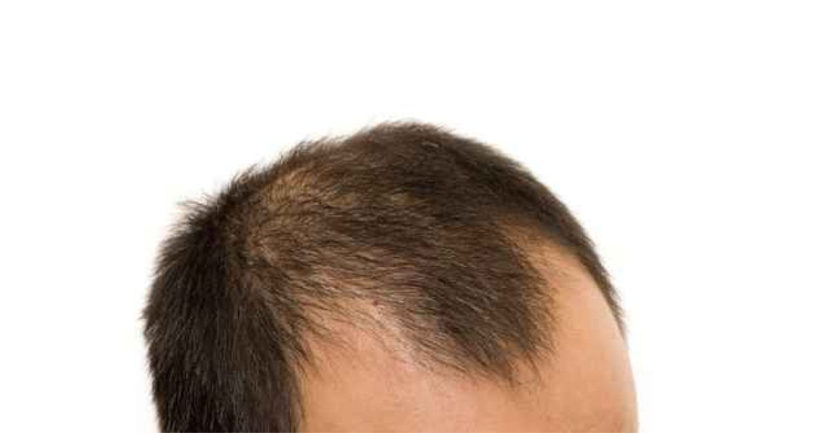 Best Hair Loss Treatments in Malaysia That You Need To Try Today