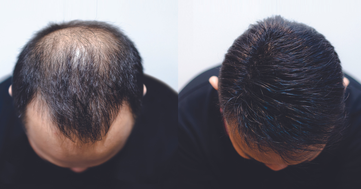 Top Hairloss Treatments for Men With Balding and Thinning Hair