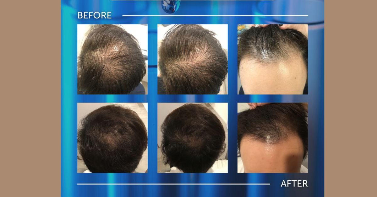 Top Hairloss Treatments for Men With Balding and Thinning Hair