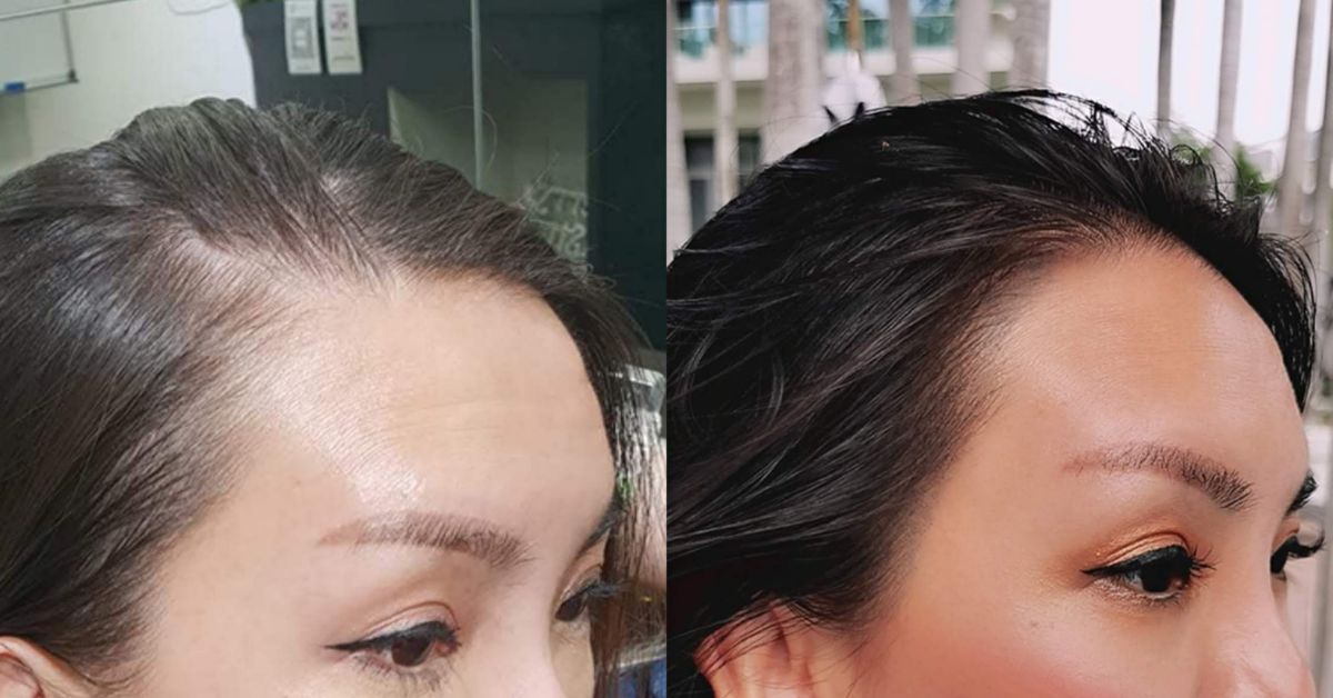 Beauty Recipe - Hairline Embroidery And Scalp Micropigmentation With Lasting Results