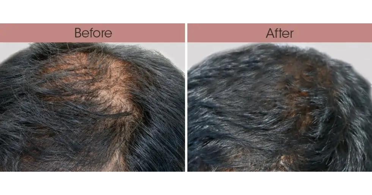 Best Non-invasive Hair Loss Treatment To Try in Singapore