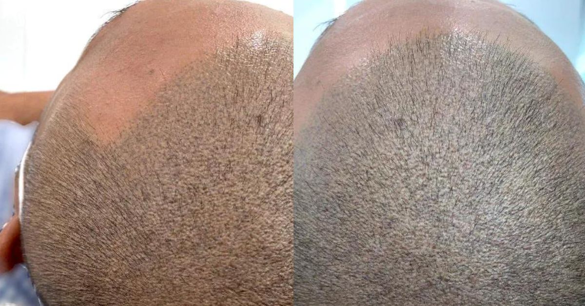 Freia Aesthetics - Scalp Micropigmentation (SMP) For Balding and Thinning Hair