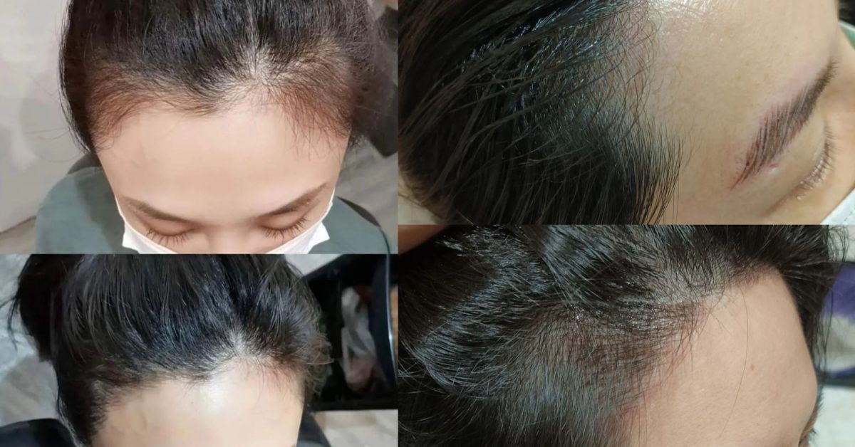 Hairline Embroidery by Jenny Xu - Expert Semi-Permanent Makeup Artist 