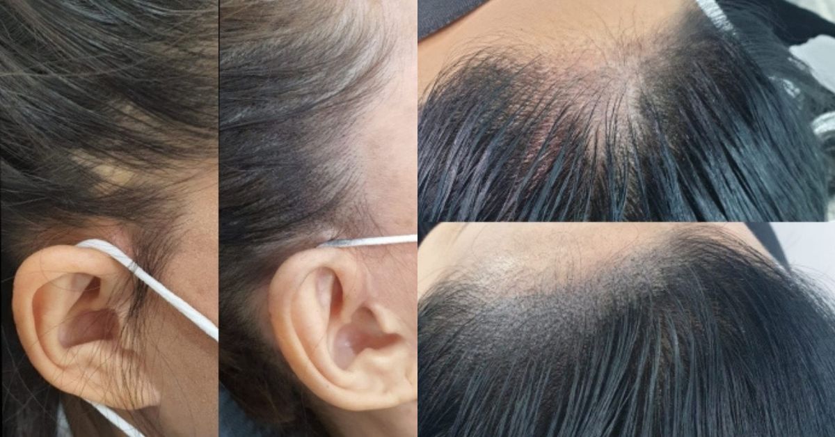 Lebelbrow Studio - Scalp Micropigmentation With Concentrated Nano Pigments