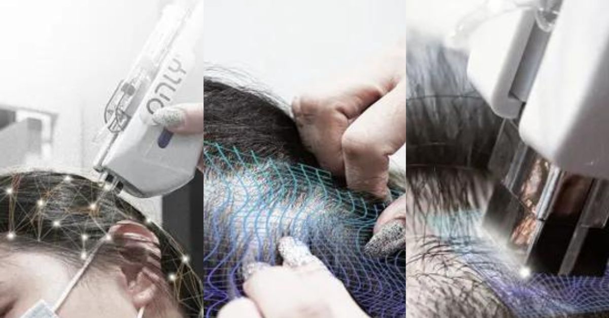 ScalpMagic Treatment by TrichOnly - Hair Transplant Alternative in Singapore