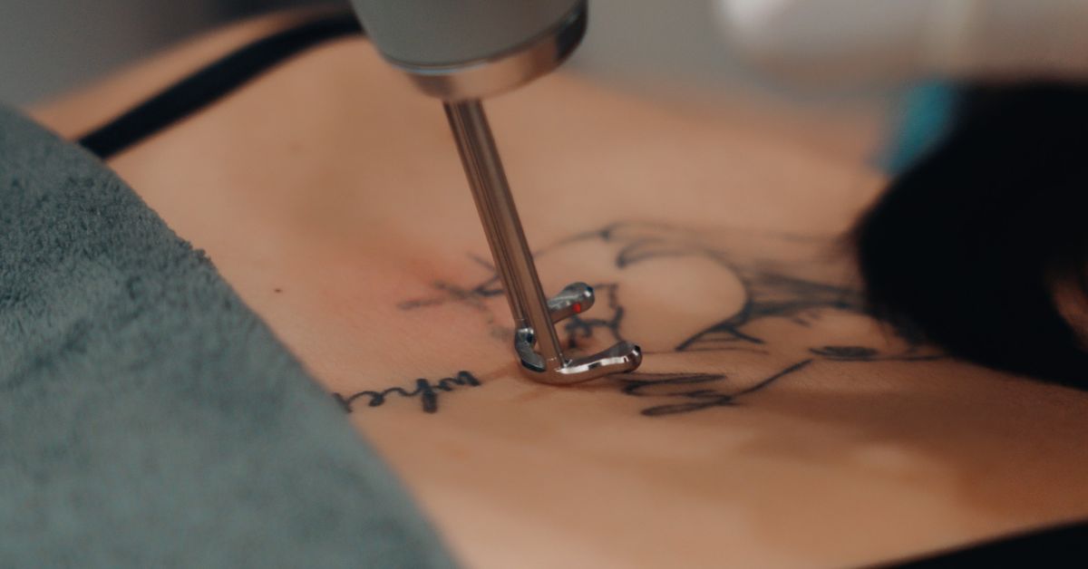 V Medical Aesthetics & Laser Clinic - Affordably Priced Laser Removal Options
