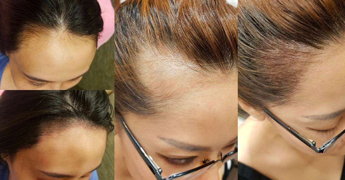 BrowArt Studio - Painless and Comfortable Hairline Embroidery