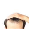 Hair Loss Solutions for Men: Top 5 Treatments for Balding and Thinning Hair Lines - Thumb